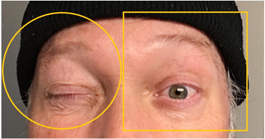 extreme close-up (selfie) in black knit cap; one eye is wide open, one eye is closed tightly. Superimposed is hollow orange square (open eye) and hollow orange circle (closed eye)